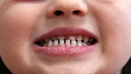FDA and RFK Jr. aim to remove fluoride supplements used to protect kids' teeth
