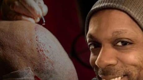 Öldüren saç ekimindeki gerçek! Basit bir işlem değil: 'Test olmazsa olmaz, 7 gün şartı var'