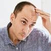 Good news for bald men! Scientists have developed a simple way to reverse hair loss - and say a treatment could be available by 2029