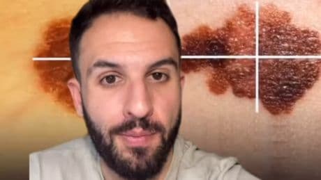 El médico y enfermero Jorge Martín explica cómo diferenciar un lunar y un melanoma: ''Sencillo y visual''