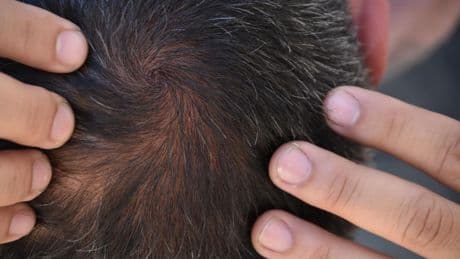 Europa confirma que un famoso fármaco para la caída del pelo puede provocar pensamientos suicidas