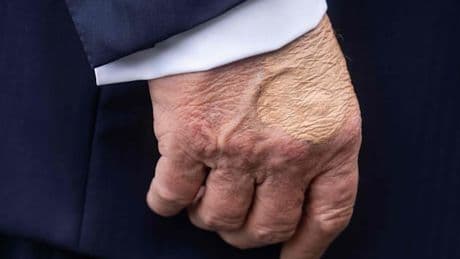 Seltsamer Fleck an Trumps Hand sorgt für Spekulationen – Weißes Haus veröffentlicht Arztbefund
