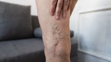 The common leg problem suffered by millions of Brits that could raise dementia risk by 23%, scientists warn