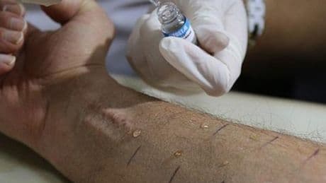 Türkiye'de toplumun yüzde 20'si alerjik belirtiler gösteriyor