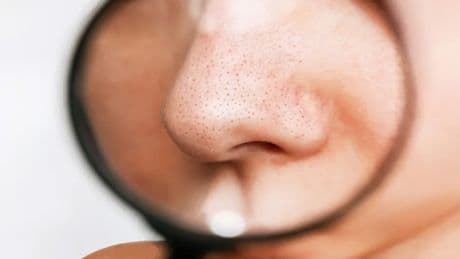 Burnundaki siyah noktaları temizlemek hiç bu kadar kolay olmamıştı! Etkisini ilk kullanımda gösteren mucize tarif