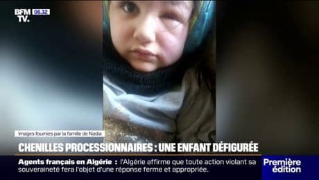 Chenilles processionnaires: une petite fille victime d'une grave inflammation à l'œil après une réaction allergique