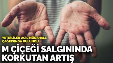 M çiçeği salgınında korkutan artış: Yetkililer acil müdahale çağrısında bulundu