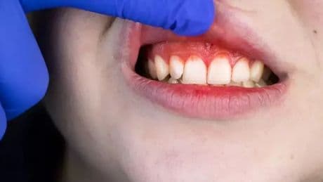 Uzman: 'C vitamini eksikliği, diş eti kanamalarına yol açabilir'