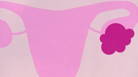 What to Do If You Get Diagnosed with an Ovarian Cyst