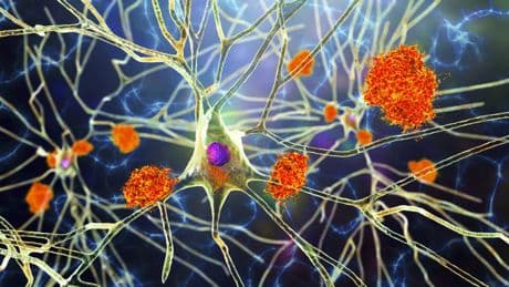 The Alzheimer’s symptoms to look out for