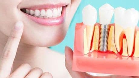 Her diş kaybı implant gerektirir! Dişsiz kalmak çene kemiğini eritiyor