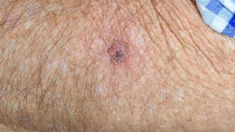 GP shares one red flag that means a spot could be skin cancer