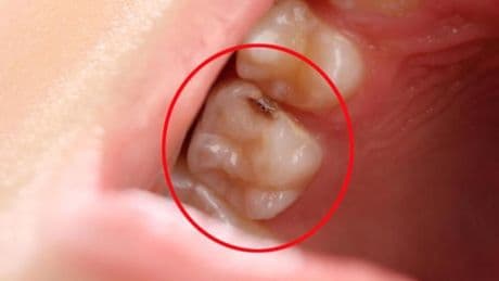 Bu yağ çürük diş ağrısına iyi geliyor! Çürük Diş Ağrısına Ne İyi Gelir, Nasıl Geçer? Diş Çürüğü Ağrısı Evde Tedavi Edilir Mi?