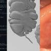 eHealth: Coden und KI in der Gastroenterologie & wo bislang der Durchbruch fehlt