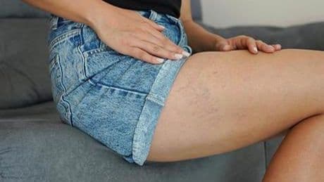 Ağrıyla başlıyor, krampla devam ediyor! Varis akciğerde pıhtıya neden oluyor