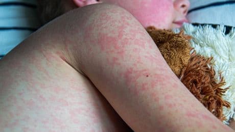 Two London boroughs record among highest measles cases in UK
