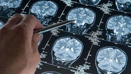 Alzheimer hastalığını erken evrede tespit edebilen kan testi geliştirildi