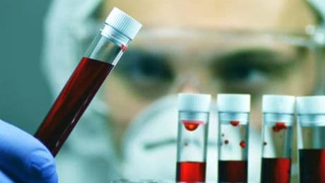 Alzheimer, Sin: "Test del sangue svolta epocale per diagnosi tempestive e cure mirate"