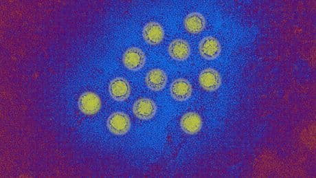 What to Know About the Hepatitis A Outbreak in L.A. County