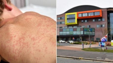 Child in Liverpool dies from measles as doctors sound alarm over vaccine take-up