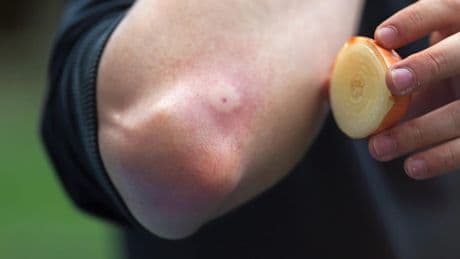 Wespenstich mit Zwiebel behandeln: Ratsam oder nicht?