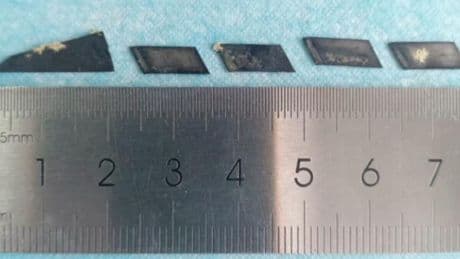 Une adolescente avale six lames de rasoir… et en expulse cinq par les voies naturelles