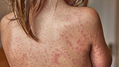 Health officials on high alert after world's most infectious disease is detected in New York City