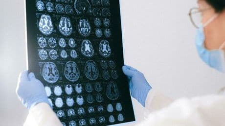 Idrocefalo Normoteso, cos'è la malattia confusa con l'Alzheimer: solo in un caso su quattro viene trattata correttamente