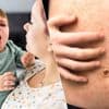 Mazelengevallen in Antwerpen en Limburg blijven toenemen: “Kijk vaccinatiestatus na”