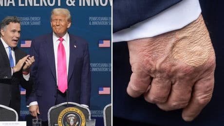 Trump’s strange bruised hand makes reappearance before president’s visit to Pittsburgh