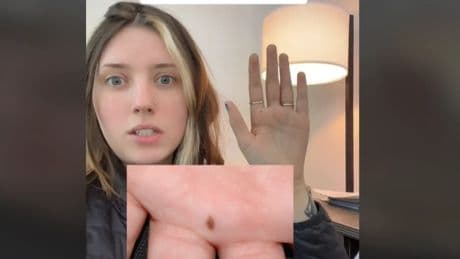 Una mujer pide a ChatGPT que le lea la mano y la IA detecta un posible cáncer de piel