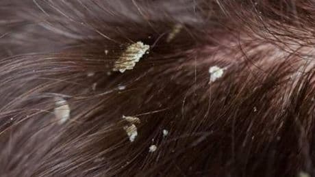 Seboreik Dermatit Nedir, Belirtileri Nelerdir? Seboreik Dermatit Tedavisi Nasıl Yapılır?