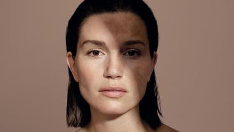 La hiperpigmentación. ¿Qué hacer para tratar y prevenir las manchas en la piel?