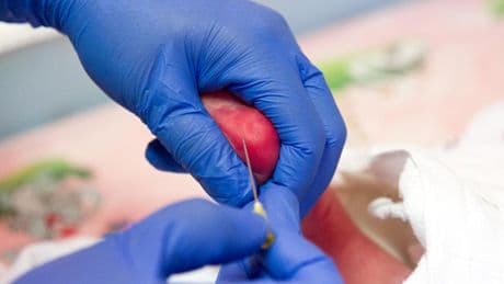 Screening neonatale: una goccia di sangue può cambiare una vita ma serve uno standard