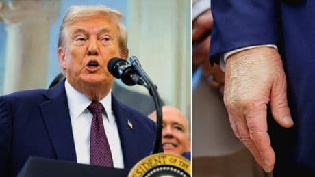 Trump blames the ‘so fake’ media for health rumors - but still sports a bruised hand in first appearance in days
