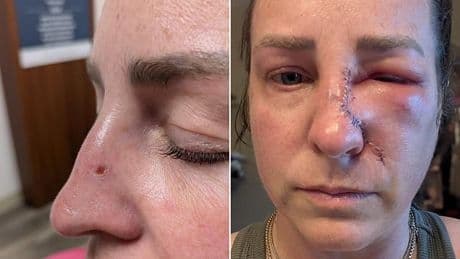 Mother-of-four, 43, reveals subtle mark she thought was just dry skin - but it was skin cancer: 'I ALWAYS wore sunscreen'