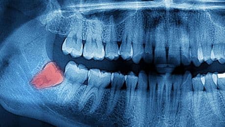 Estudian la mandíbula humana y encuentran un nuevo uso para las muelas del juicio