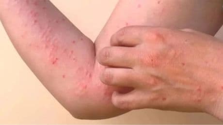 Türkiye kırmızı alarm listesinde, Chikungunya salgını