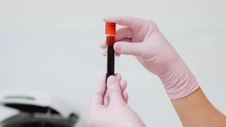 Potassio alto nel sangue: attenzione a questi sintomi