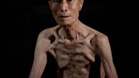Powerful AP photos show the scars of a survivor of the Nagasaki atomic bombing