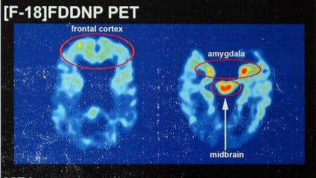 NYC shooting suspect claimed he had CTE: What to know about the disease