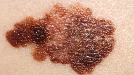 Científicos españoles descubren un 'GPS' del melanoma que podría ayudar a frenar la metástasis