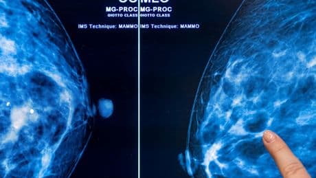 Medizin: Was bringt das Mammografie-Screening?