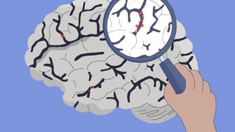 Medizin: Wie fängt Alzheimer an?