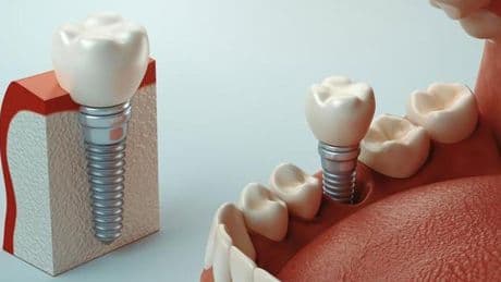 İmplant Nedir, Nasıl Yapılır? İmplant Tedavisi Kimlere Uygulanır?
