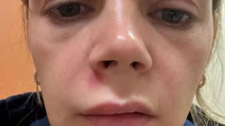 Woman hospitalised after popping spot in her 'triangle of death'