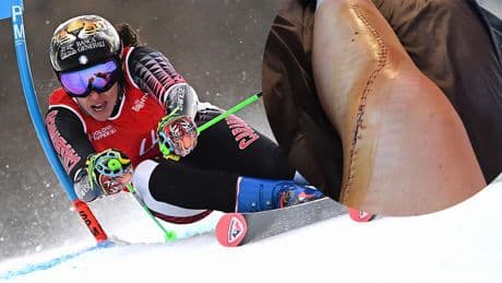 42 Stiche! - Ski-Star zeigt Mega-Narbe nach Horror-Unfall