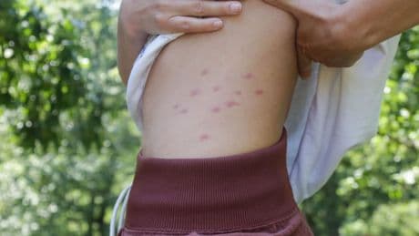 Flohbisse erkennen: Parasiten bei Mensch und Tier erkennen