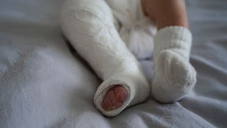 Klumpfuß bei Kindern: Behandlung und Nachsorge