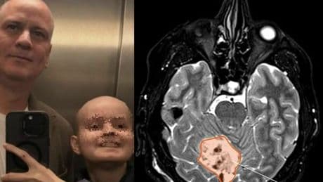 Medulloblastoma, la malattia del figlio di Julio Sergio: Enzo lotta con un tumore al cervelletto. Il piccolo è in coma indotto